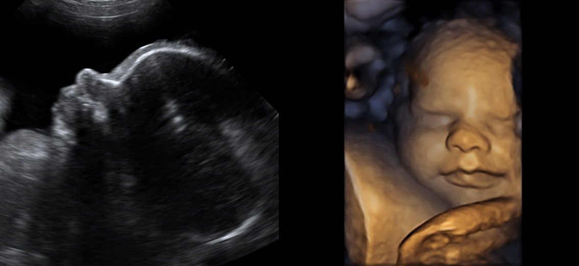 Escáner de ultrasonido para embarazo