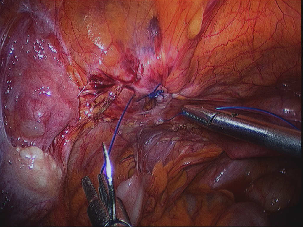 Endoscopio laparoscópico